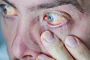 Human eye with yellow eyeball, closeup. Yellow eyes is a symptom of liver disease or hepatitis.