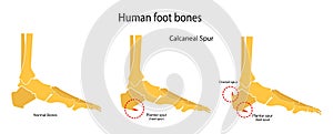 Human foot bones. Plantar and dorsal spur calcaneal spur. Illustration photo