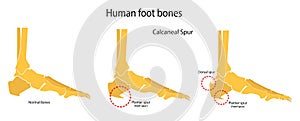 Human foot bones. Plantar and dorsal spur calcaneal spur. Illustration photo