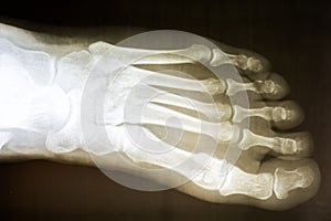 Human Foot X-Ray
