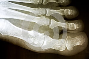 Human Foot X-Ray