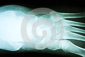 Human Foot X-Ray