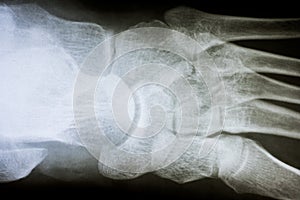 Human Foot X-Ray