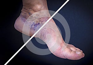 Human foot with varicose veins before and after