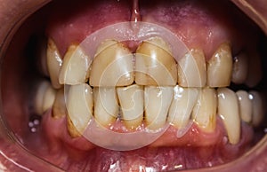Human front teeth for prosthetics with ceramic veneers. Teeth before treatment.