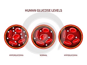 Human glucose levels hyperglycemia, normal, hypoglycemia. Hematology vector diagram with blood vessel, erythrocytes and