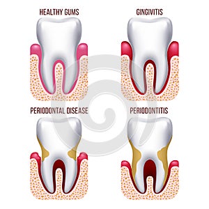 Human gum disease, gums bleeding. Tooth prevention dental, oral care vector infographics