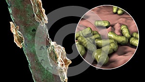 Human hair with dandruff and close-up view of microscopic fungi Malassezia furfur