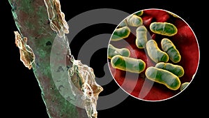 Human hair with dandruff and close-up view of microscopic fungi Malassezia furfur