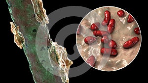 Human hair with dandruff and close-up view of microscopic fungi Malassezia furfur