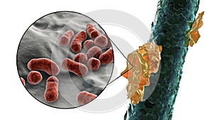 Human hair with dandruff and close-up view of microscopic fungi Malassezia furfur