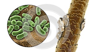Human hair with dandruff and close-up view of microscopic fungi Malassezia furfur