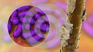 Human hair with dandruff and close-up view of microscopic fungi Malassezia furfur