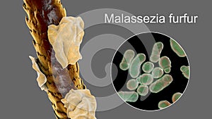 Human hair with dandruff and close-up view of microscopic fungi Malassezia furfur