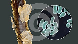 Human hair with dandruff and close-up view of microscopic fungi Malassezia furfur