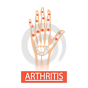 Human Hand with Arthritis Medical Vector Illustration. Swollen, Distorted Hand With Limited Mobility