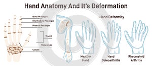 Human hand bones and its deformations. Anatomical structure