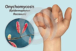 Human hand with onychomycosis
