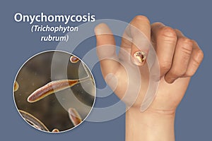 Human hand with onychomycosis