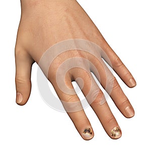 Human hand with onychomycosis