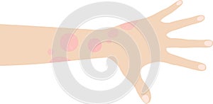 Human hand with tetter