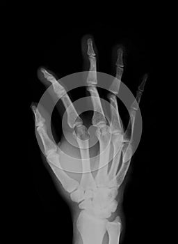 Human hand Xray Negative Scan