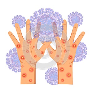 Human hands affected by a rash, purulent ulcers
