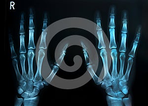 human hands x ray