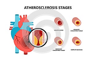 Human heart anatomy with atherosclerotic plaque. Cholesterol plaque in the blood vessels.