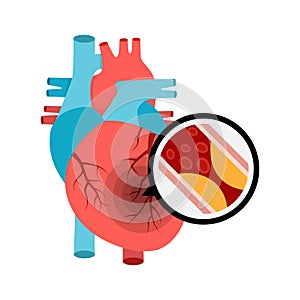 Human heart anatomy with heart attack. Atherosclerotic plaque in the blood vessels.