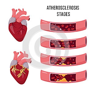 Human heart and Atherosclerosis stages.