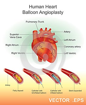 Human Heart Balloon Angioplasty. photo