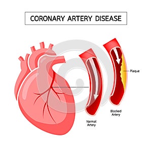 Human heart with Coronary Artery Disease info graphic.