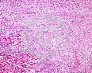 Human heart myocardium. Ischemic infarct