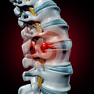 Human Herniated Disk photo