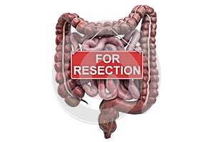 Human intestines with For Resection hanging sign, 3D rendering