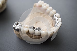 Human jaw layout with ceramic and metal dentures