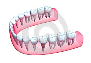 Human jaw model with teeth and implant.