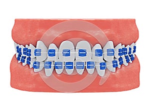 Human jaws with healthy teeth and blue braces