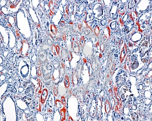 Human kidney. Amyloidosis, Congo red