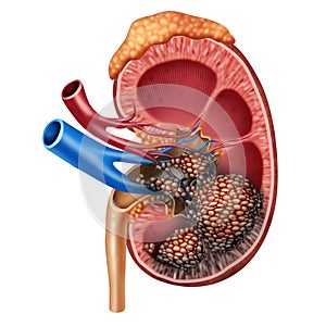 Human Kidney Cancer Anatomy