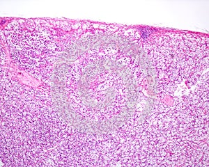 Human kidney. Clear cell renal carcinoma