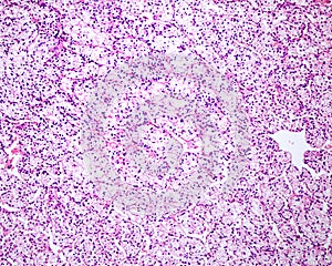 Human kidney. Clear cell renal carcinoma