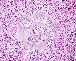 Human kidney. Diabetic nephropathy