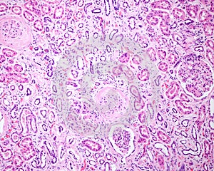 Human kidney. Diabetic nephropathy