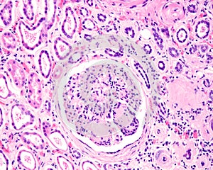 Human kidney. Diabetic nephropathy