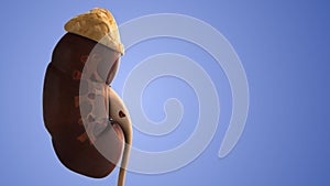 Human kidney stones medical animation