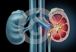 Human kidney Stones Medical Concept