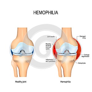 Human knee with hemophilia and healthy joint