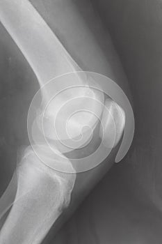 Human knee-joint with kneecap on X-ray image